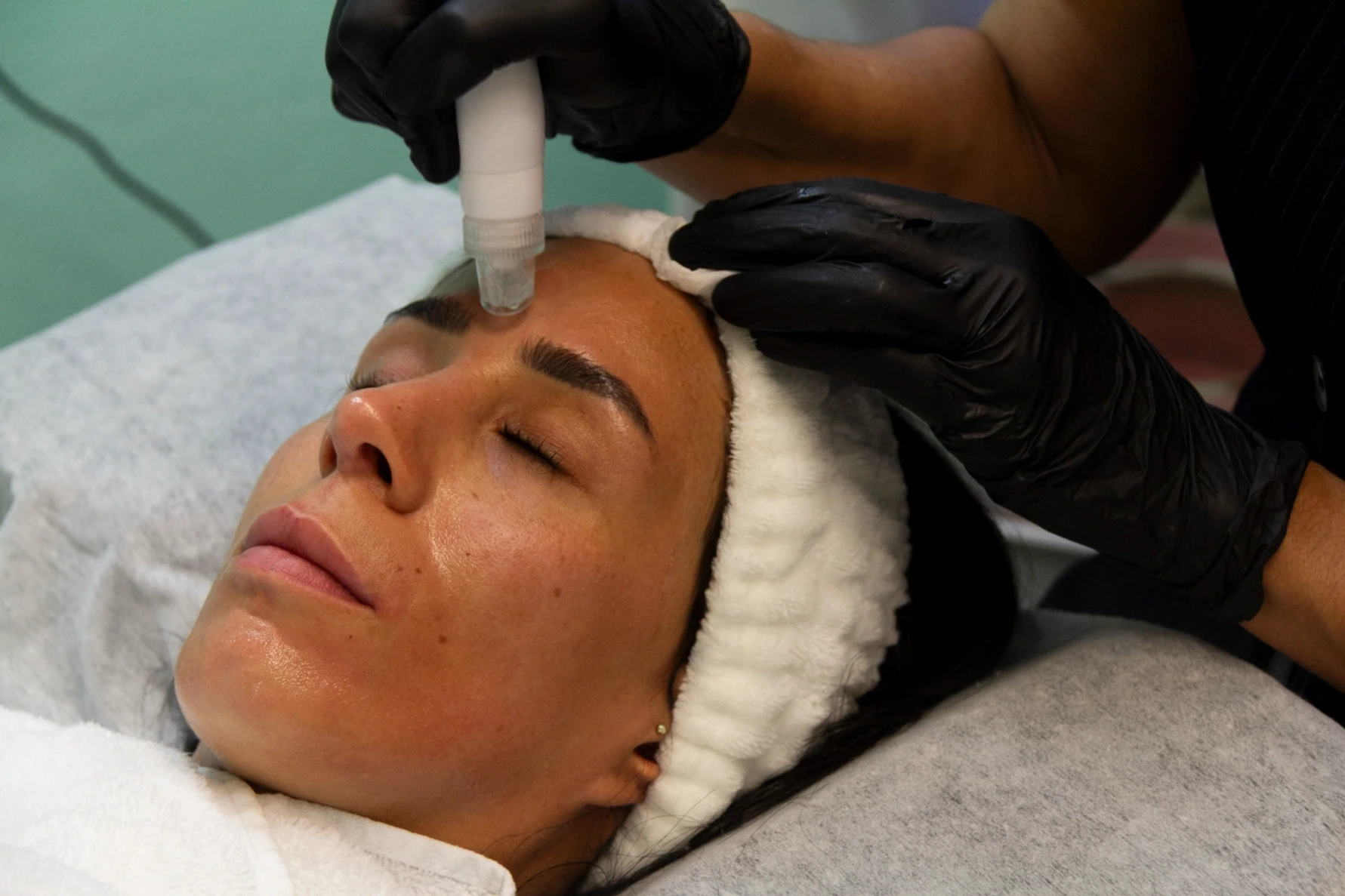 Vorher-Nachher-Ergebnis einer Aqua Facial und Fruchtsäurebehandlung im Kosmetikstudio Ginié in Heidelberg.