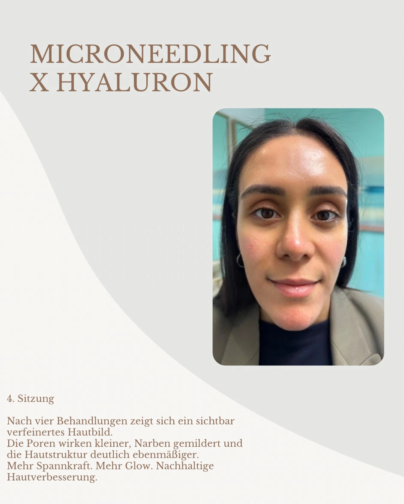 Vorher-Nachher-Ergebnis einer Needling mit Hyaluron Behandlung im Kosmetikstudio Ginié in Heidelberg.