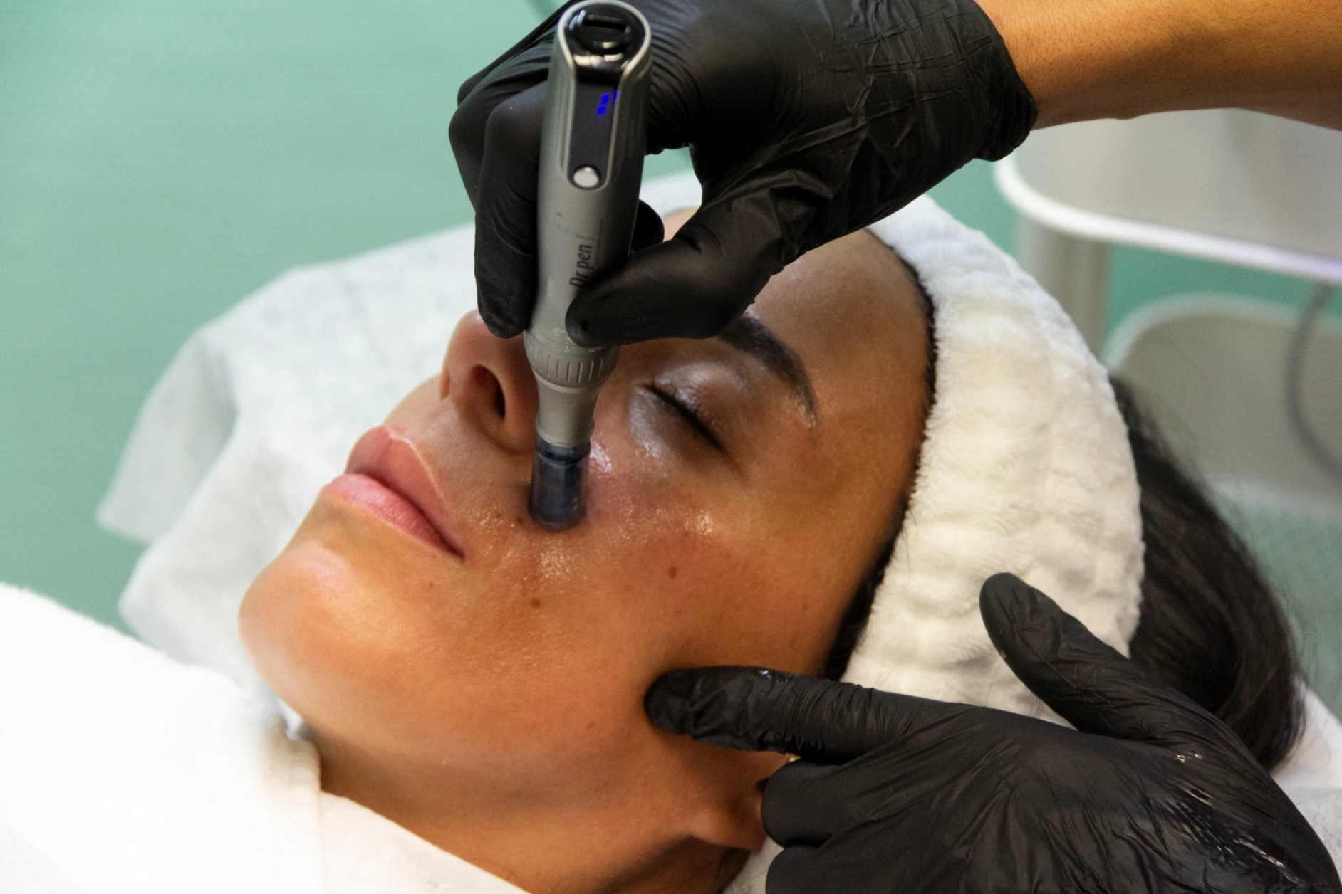 Needling mit Hyaluron Behandlung im Kosmetikstudio Ginié in Heidelberg.